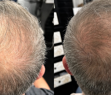 HAIR GROWTH RESTORATION